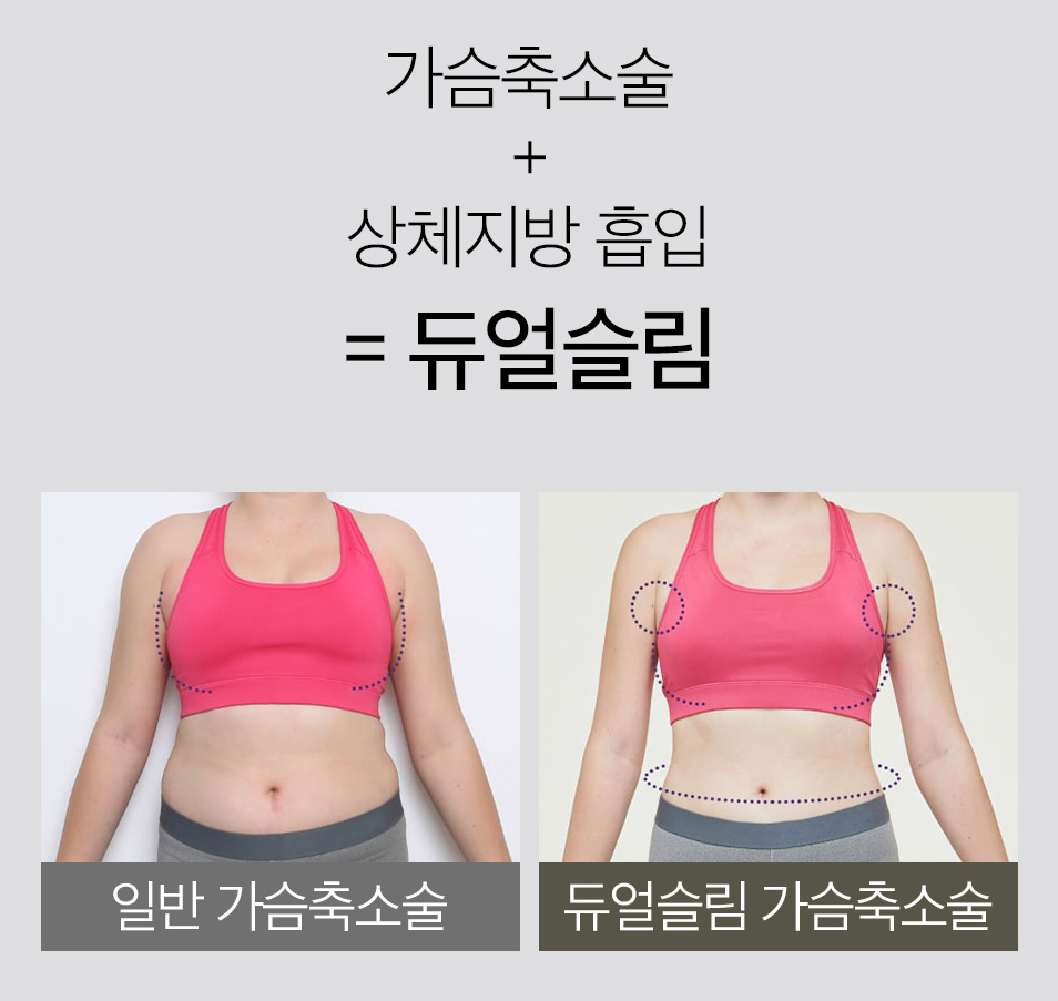 신체 균형까지 고려한 바노바기 가슴 축소 수술법 관련 이미지 7