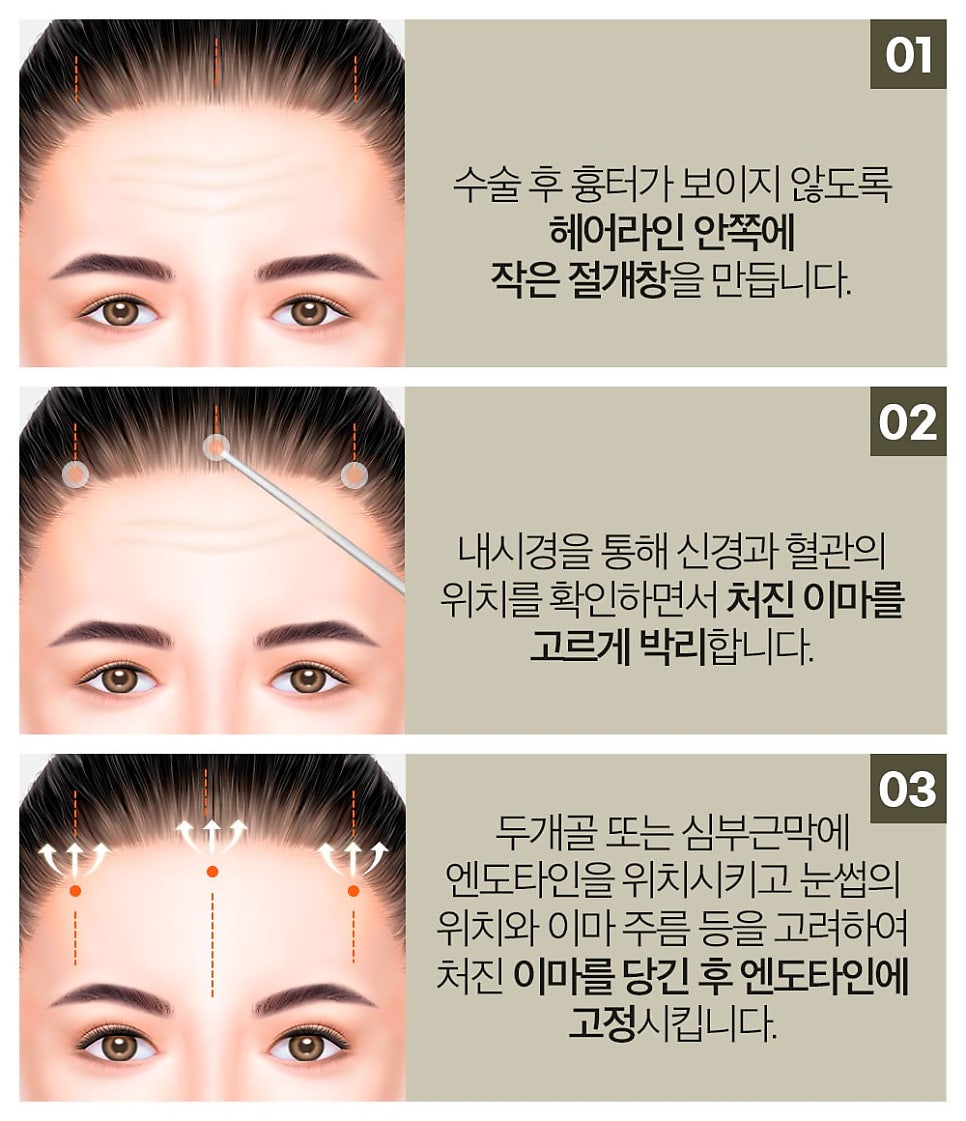 처지고 주름진 이마, 엔도타인 이마 리프팅으로 개선 관련 이미지 4