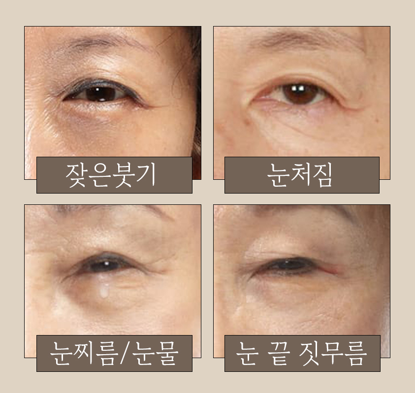 노화로 인한 눈꺼풀 처짐, 바노바기 비절개 상안검으로 개선! 관련 이미지 2