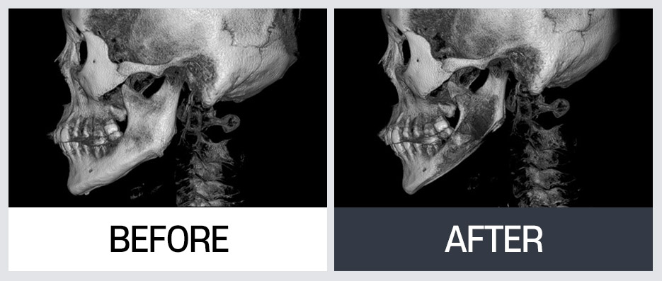 윤곽 재수술의 다양한 케이스와 수술 방법 관련 이미지 4