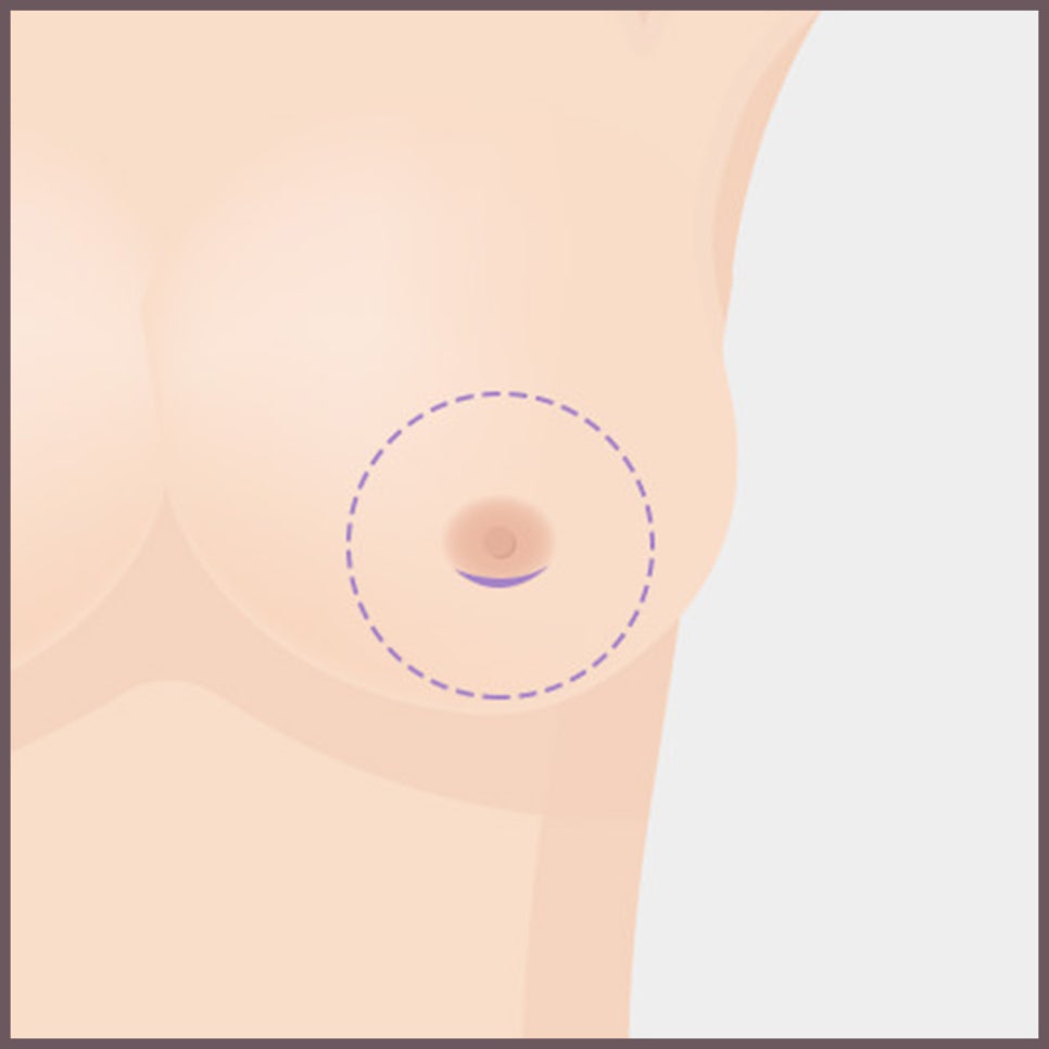 가슴 성형 수술의 핵심! 보형물의 종류와 위치, 절개법 관련 이미지 9