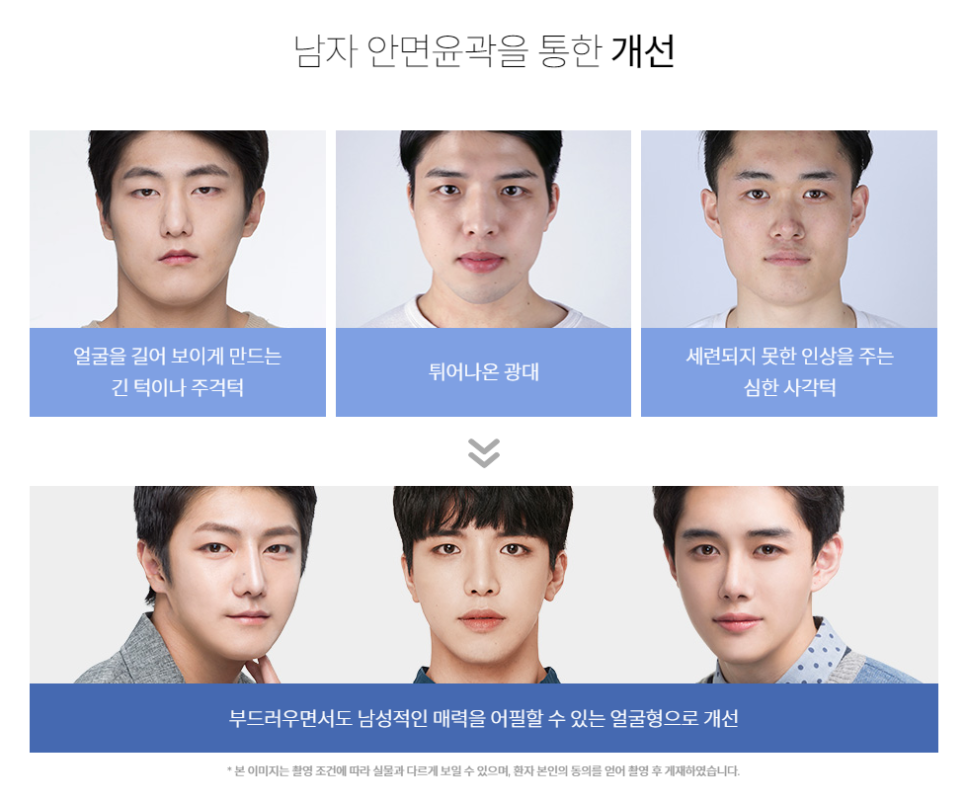 남자턱성형 22년 전문의가 중요하게 생각하는 부분은? 관련 이미지 4