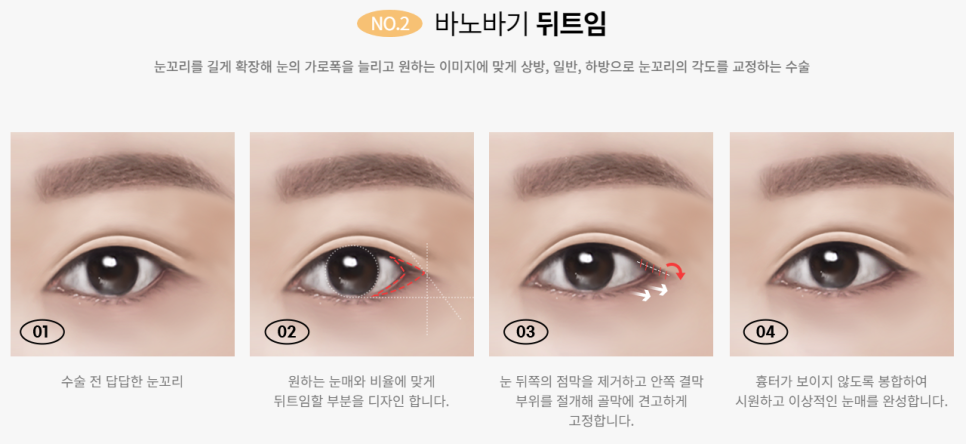 내 눈의 숨겨진 1mm를 찾아내다! 바노바기 트임성형 관련 이미지 4