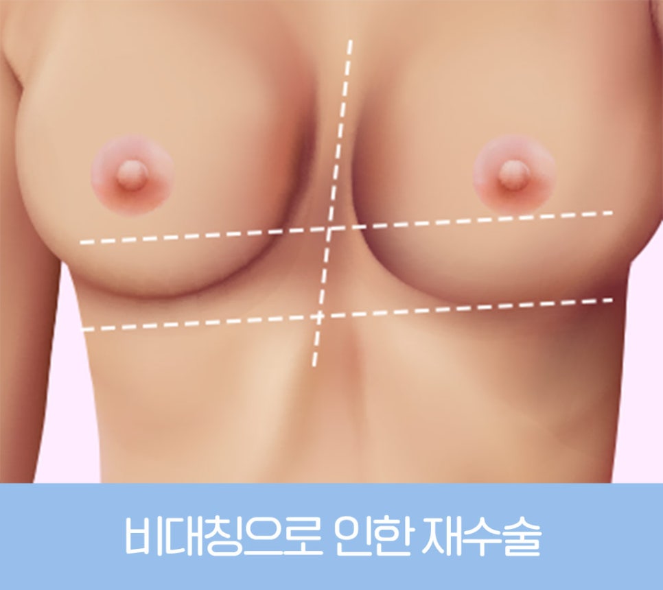 가슴 재수술, 원인에 따라 달라지는 개선 방법 관련 이미지 4