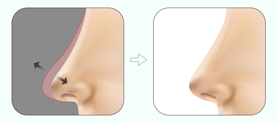 코 재수술! 원인에 따라 달라지는 수술법 관련 이미지 6