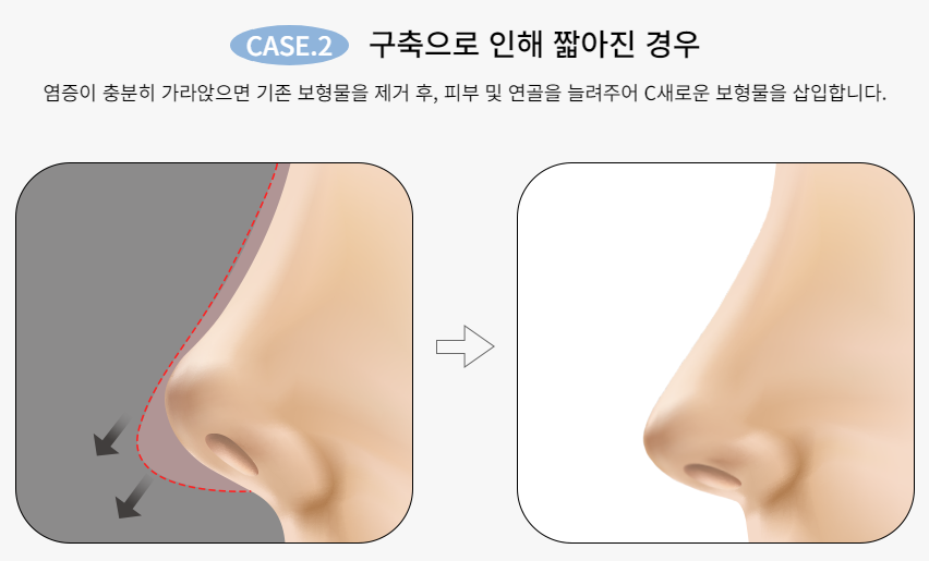 마지막 코재수술, 바노바기에서! 관련 이미지 4