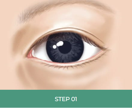 눈 밑 주름, 다크서클 눈 밑 지방재배치로 개선할 수 있습니다. 관련 이미지 4