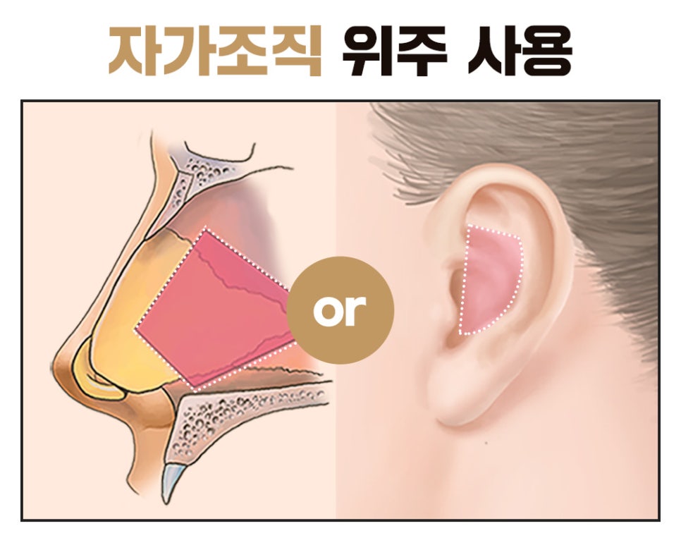 바노바기 코 성형, 나에게 어울리는 라인으로 한 번에 개선 관련 이미지 5