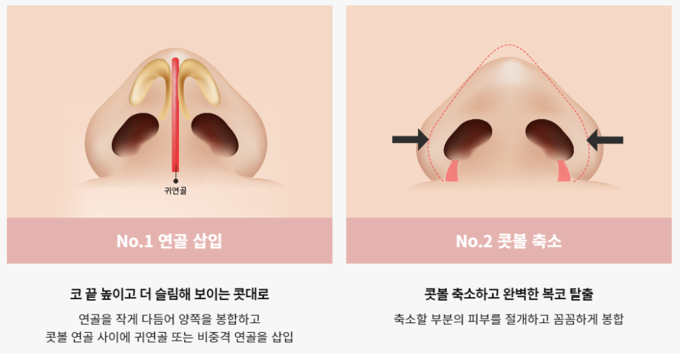 통통하고 뭉툭한 코, 슬림하고 오똑하게! 복코 성형 관련 이미지 6