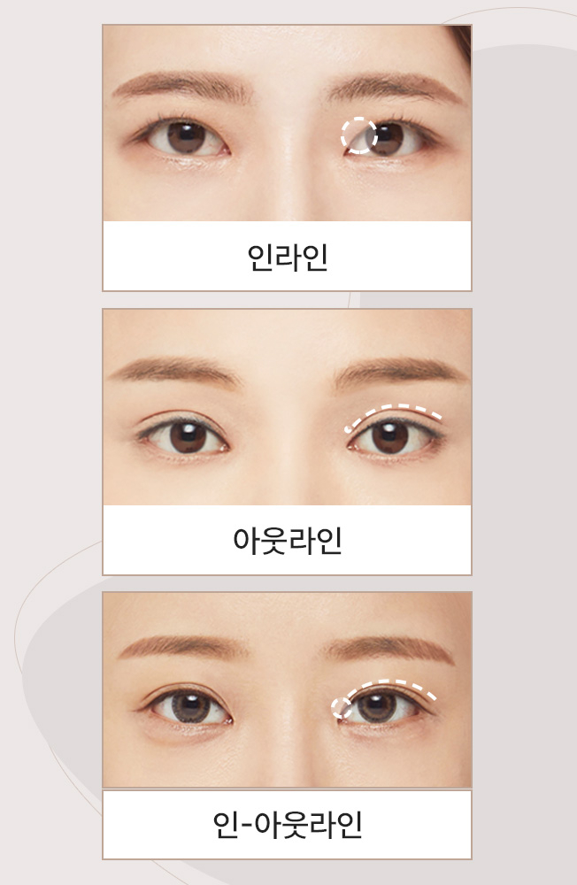 절개 쌍꺼풀 수술도 매몰처럼 자연스러운 라인이 가능한 이유! 관련 이미지 2
