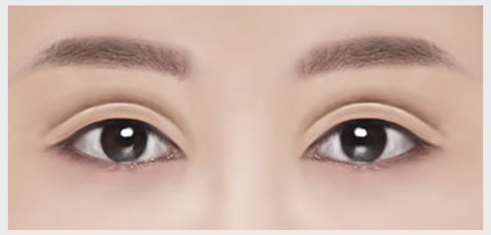 쌍꺼풀 재수술이 필요한 유형과 원인에 맞는 재수술 방법 관련 이미지 2