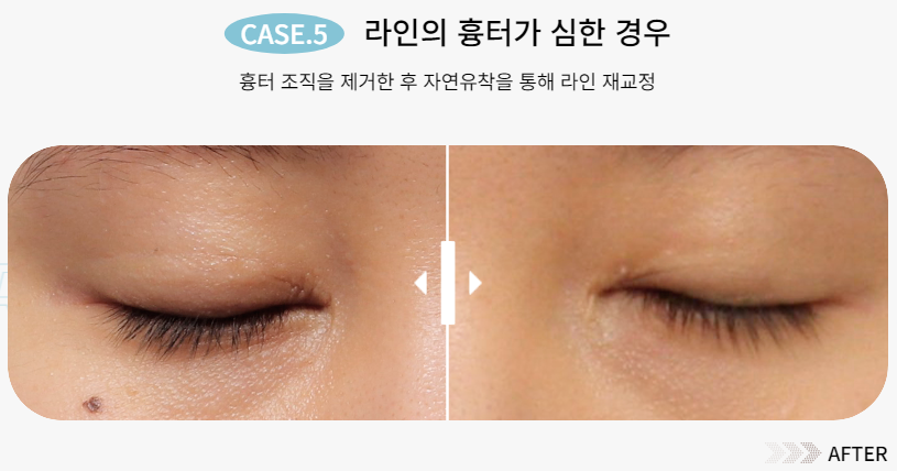예쁜 눈매를 되찾는 방법, 눈 재수술 관련 이미지 7