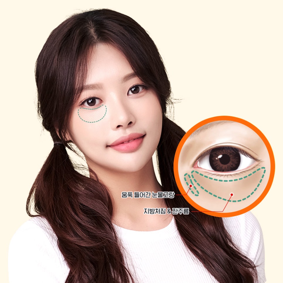다크서클, 눈 밑 꺼짐, 눈 밑 주름 눈밑지방재배치로 한 번에 개선! 관련 이미지 2