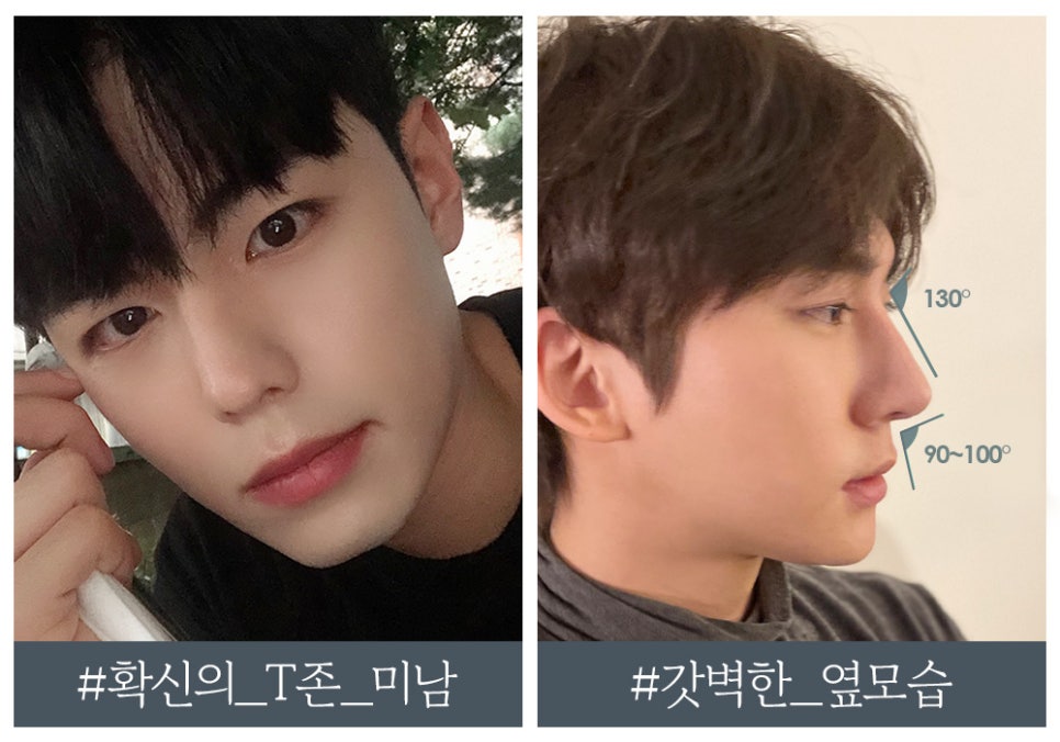 남자 코성형, 코 라인에 따라 달라지는 수술 방법 관련 이미지 2