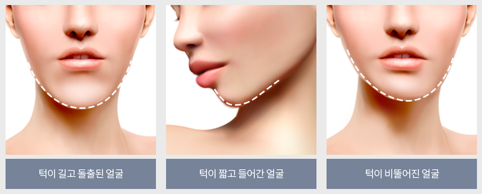 작은 얼굴을 결정짓는 선명한 라인, 절골 앞턱수술 관련 이미지 2