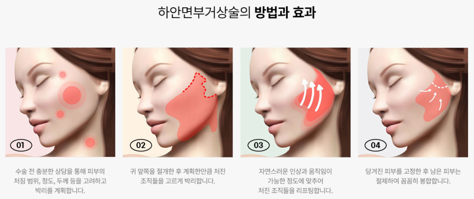 근막층까지 당겨 더욱 강력하게! 하안면부거상술 관련 이미지 2