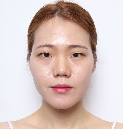 광대축소전후 22년 경력의 전문의의 실력, 궁금하신가요? 관련 이미지 4