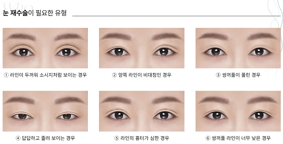예쁜 눈매를 되찾는 방법, 눈 재수술 관련 이미지 2