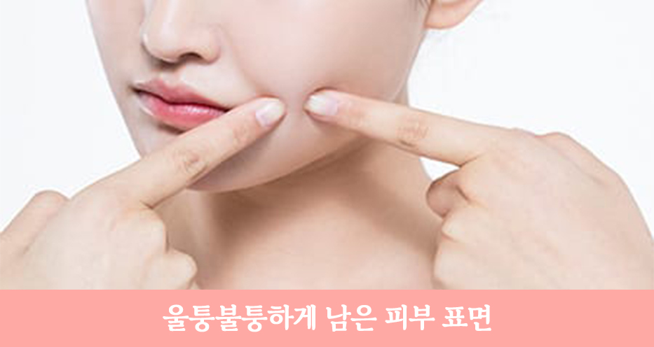 안면거상 재수술, 정확한 원인 분석으로 확실한 개선! 관련 이미지 4