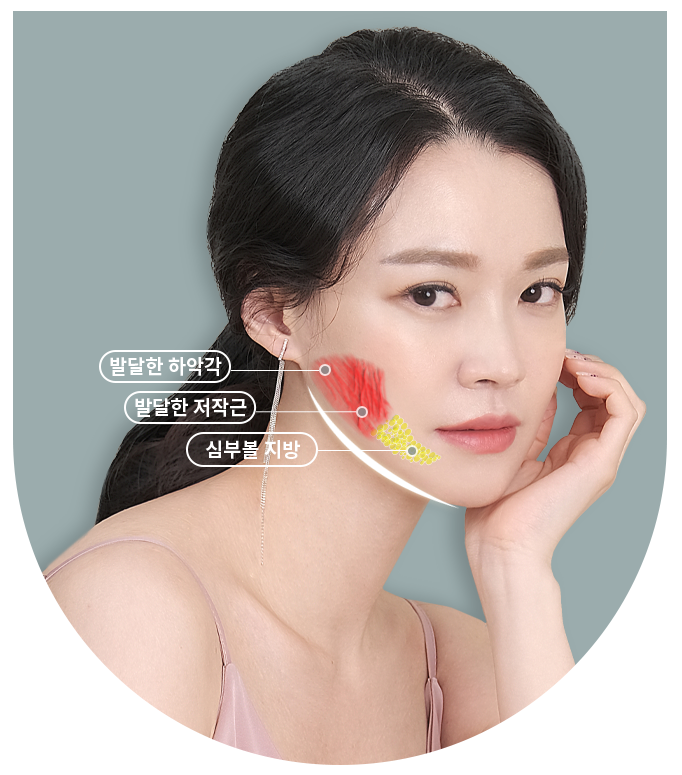 어느 각도에서든 날렵하게, 사각턱 수술 관련 이미지 2