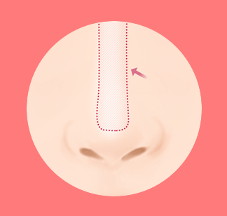 코성형보형물 코재수술 부작용이 있다면? 설명드립니다. 관련 이미지 6