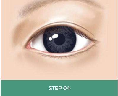 눈 밑 주름, 다크서클 눈 밑 지방재배치로 개선할 수 있습니다. 관련 이미지 7