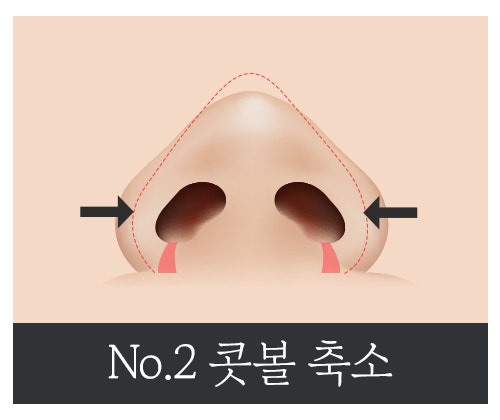 복코 성형, 뭉툭한 코를 세련되고 슬림한 코로 개선 관련 이미지 7