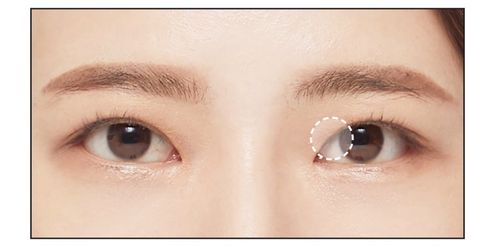 절개 쌍꺼풀의 수술법과 절개법이 필요한 경우 관련 이미지 5