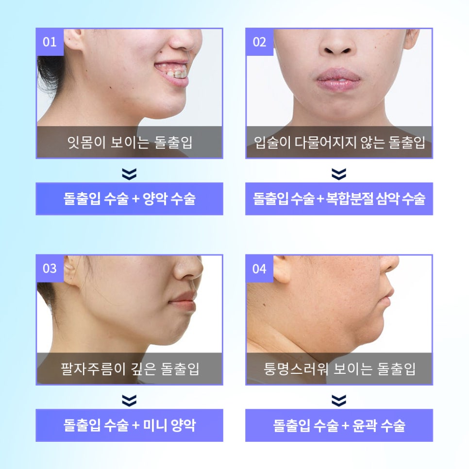 유형에 따라 달라지는 돌출입 수술 방법 관련 이미지 8