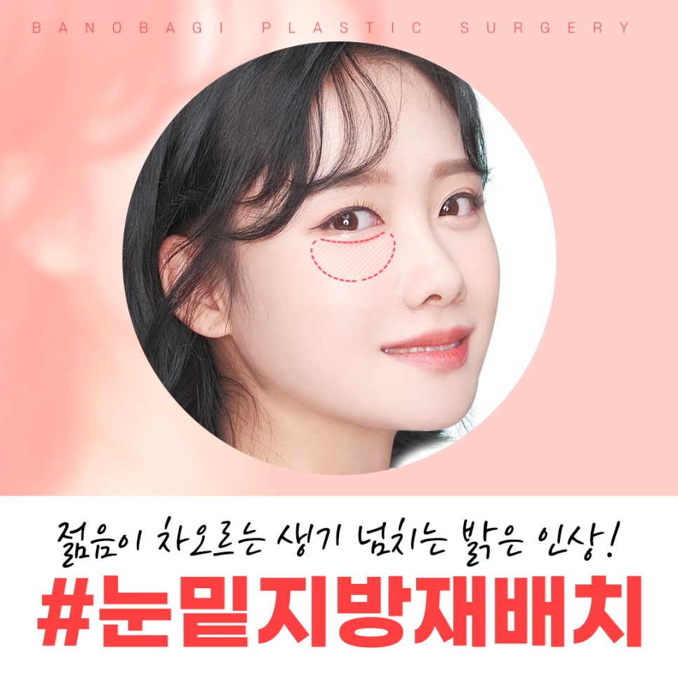 눈 밑 주름, 다크서클 눈 밑 지방재배치로 개선할 수 있습니다. 관련 이미지 1