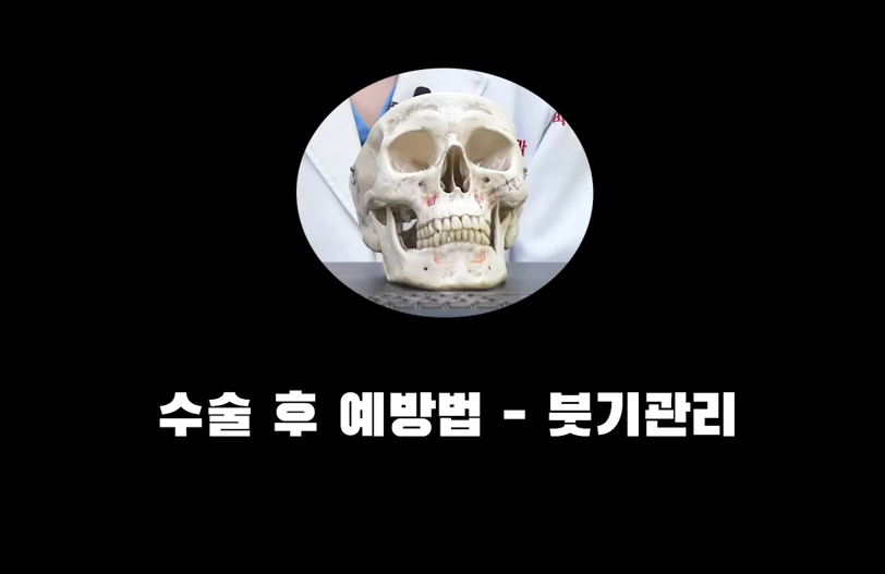 안면윤곽 수술 후 처짐 예방의 모든 것 관련 이미지 4