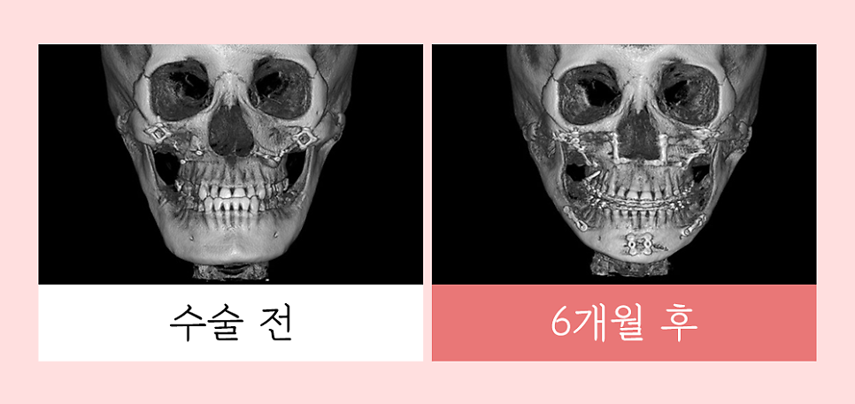 윤곽 재수술의 다양한 원인과 개선 방법! 관련 이미지 7