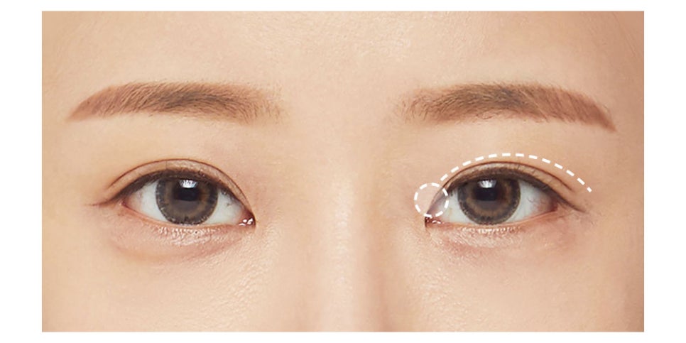 절개 쌍꺼풀, 원하는 라인으로 흉터 걱정 없이 한 번에 개선 관련 이미지 6