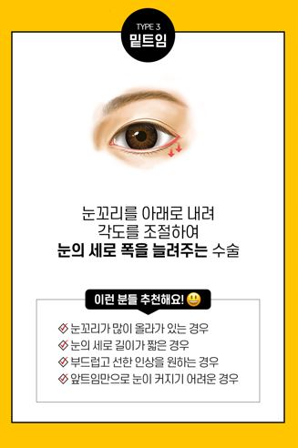 트임성형은 내 얼굴에 맞게 조화로운 비율로! 관련 이미지 5