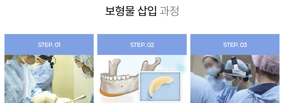 작은얼굴의 핵심은 앞턱수술을 어떻게 깎는가입니다. 관련 이미지 10