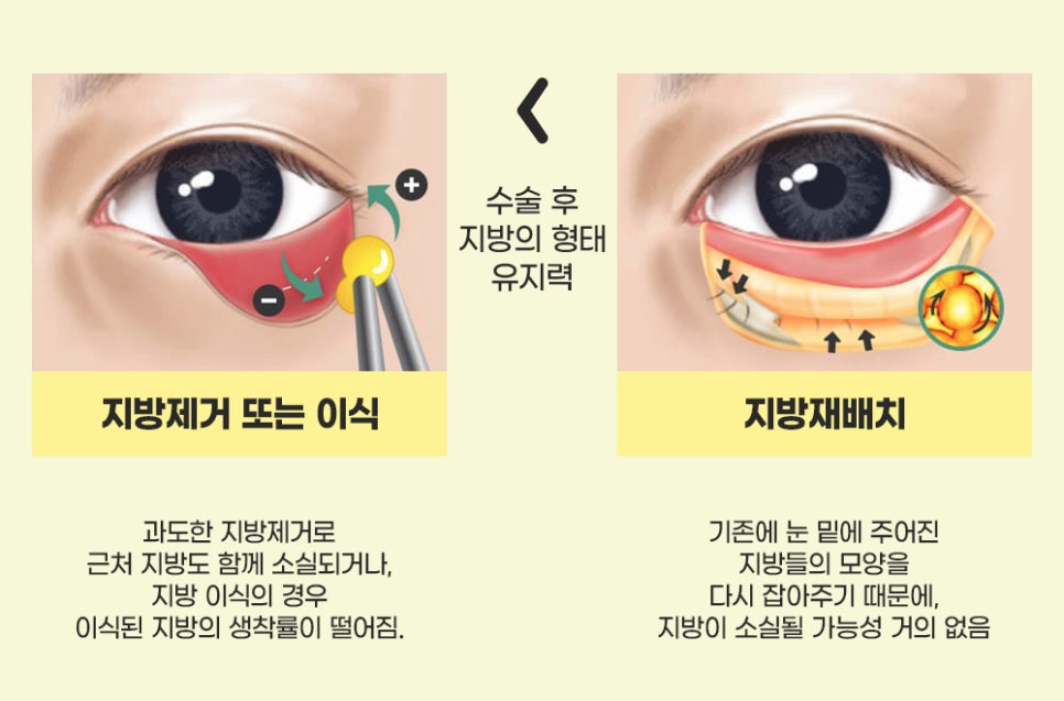 눈 밑 지방재배치로 다크서클, 눈 밑 주름 개선할 수 있습니다. 관련 이미지 3