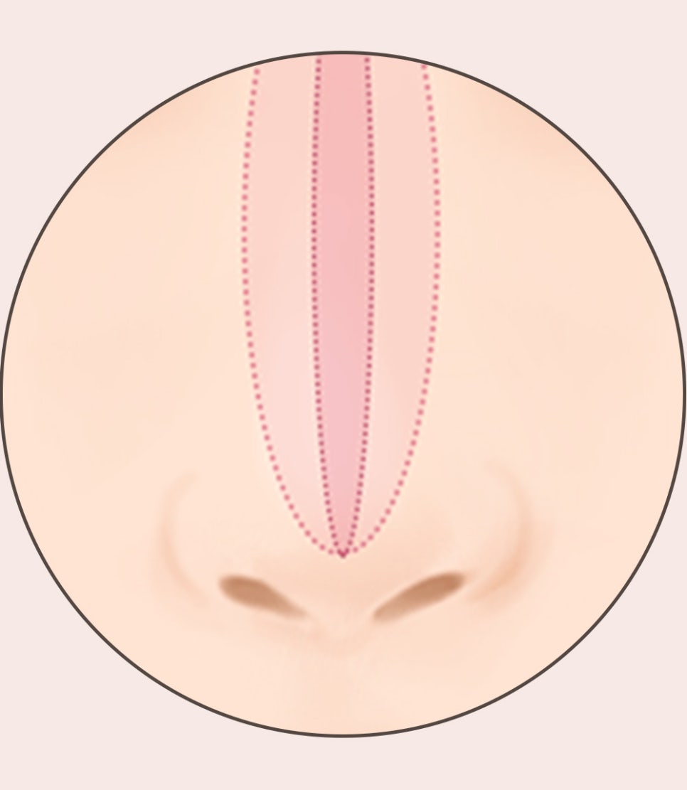코 재수술의 다양한 원인과 개선 방법! 관련 이미지 10