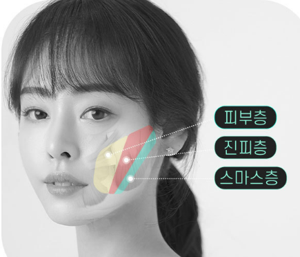 바노바기 미니V리프팅으로 피부 탄력과 턱선 개선까지! 관련 이미지 3