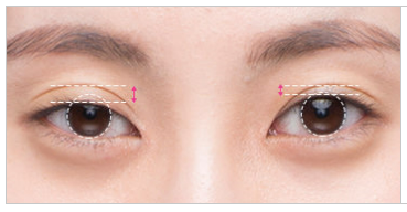 눈재수술, 더 이상 망설이지 마세요! 관련 이미지 4