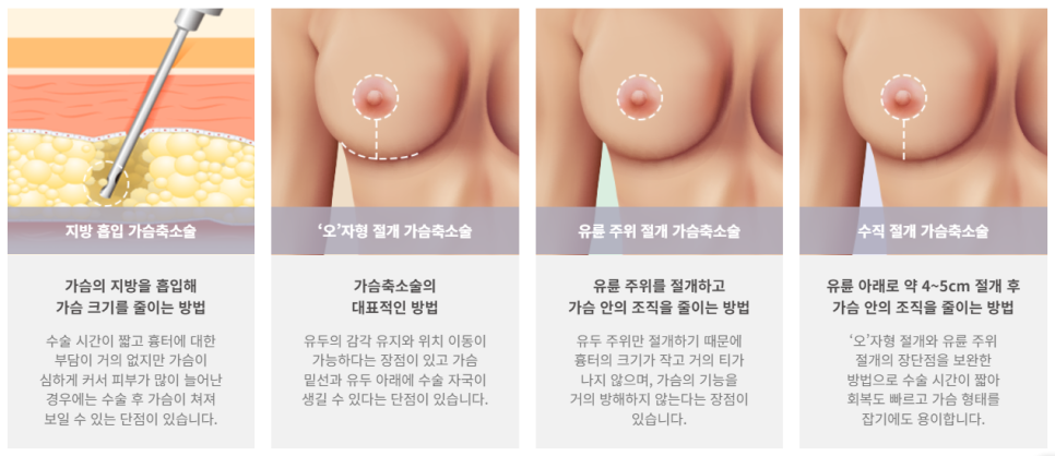 신체 균형을 위한 가슴 축소술! 관련 이미지 3