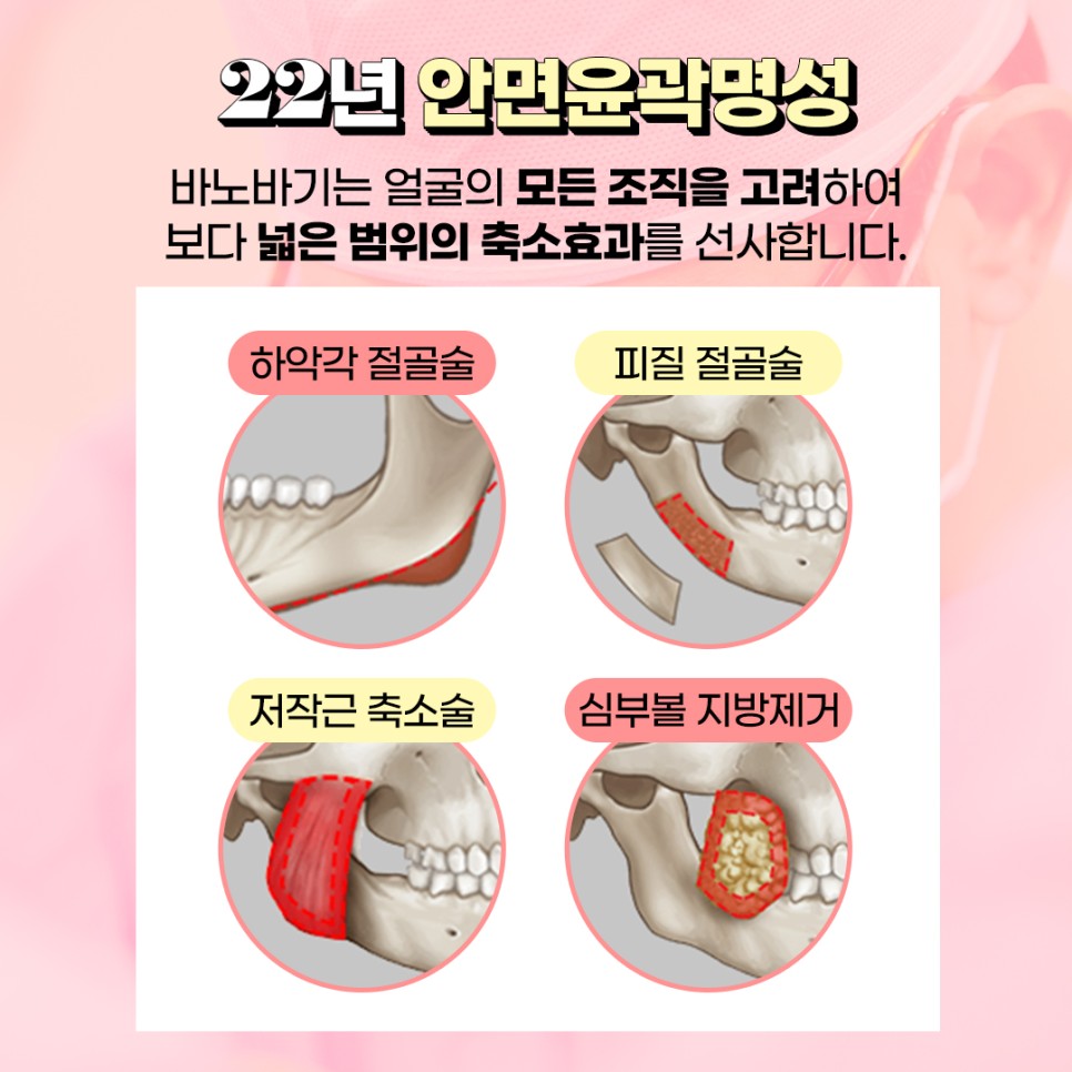 나에게 맞는 사각턱 수술 방법 찾기! 관련 이미지 2