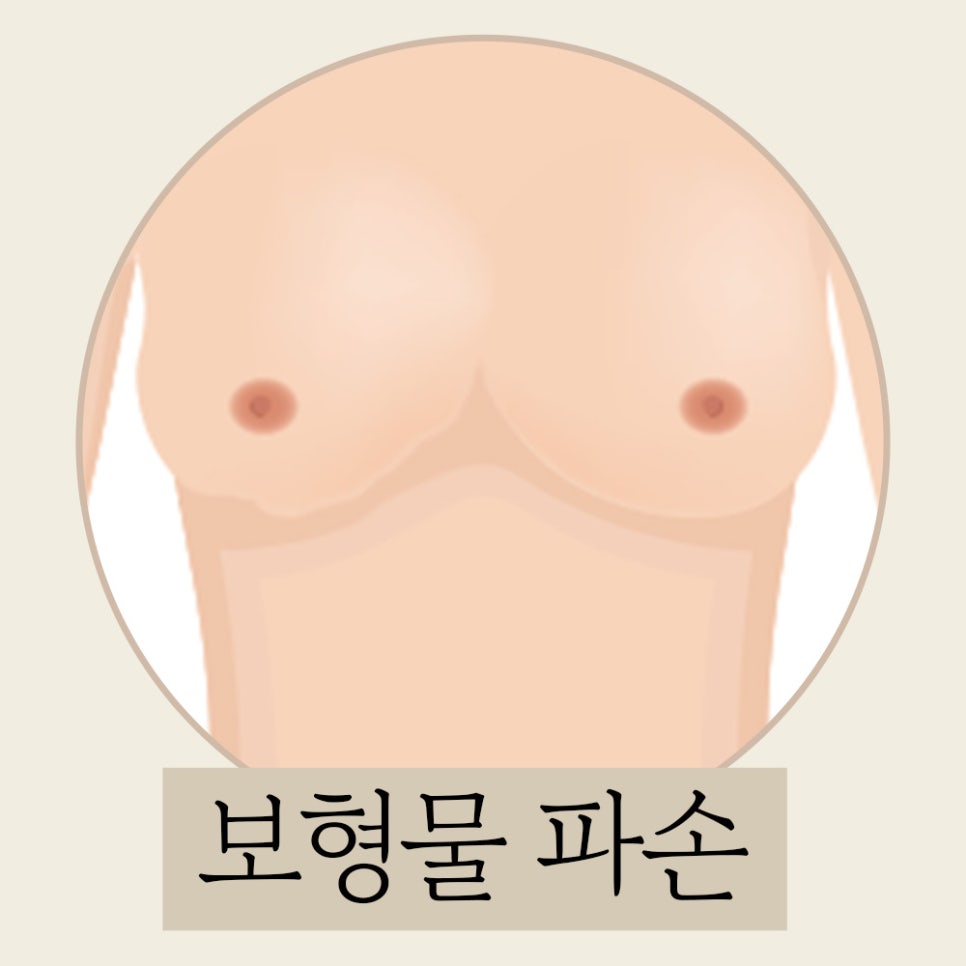 가슴 재수술의 원인과 적합한 시기 관련 이미지 6