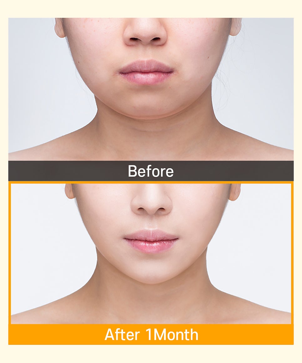 뼈 수술 없이 얼굴형 개선이 가능한 바노바기 미니V리프팅 관련 이미지 6