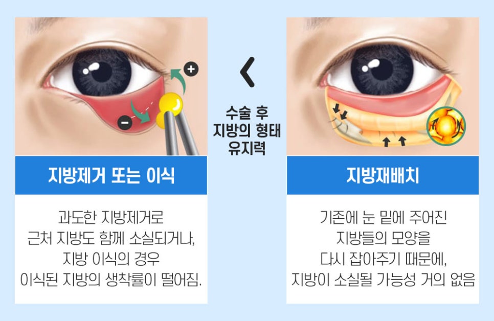 눈밑 지방재배치, 볼록하고 어두운 눈가를 환하게 개선 관련 이미지 3