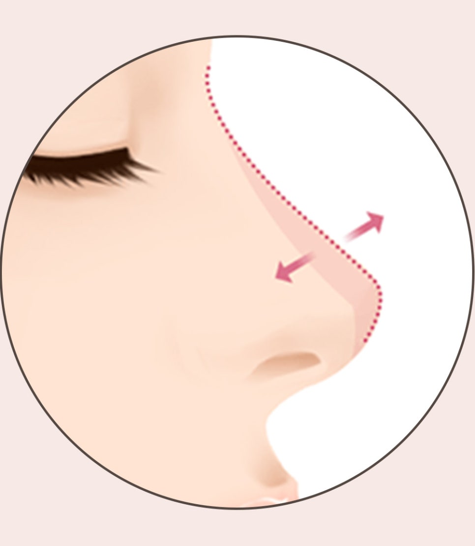 코 재수술의 다양한 원인과 개선 방법! 관련 이미지 8