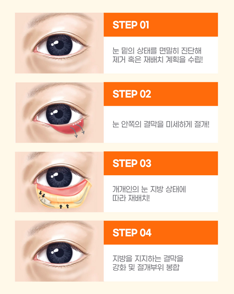 다크서클, 눈 밑 꺼짐, 눈 밑 주름 눈밑지방재배치로 한 번에 개선! 관련 이미지 4