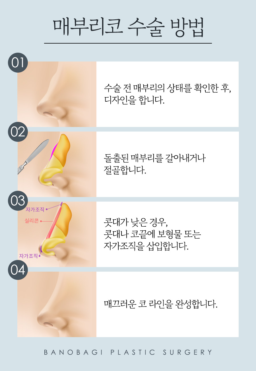 남자 코성형, 코 라인에 따라 달라지는 수술 방법 관련 이미지 5
