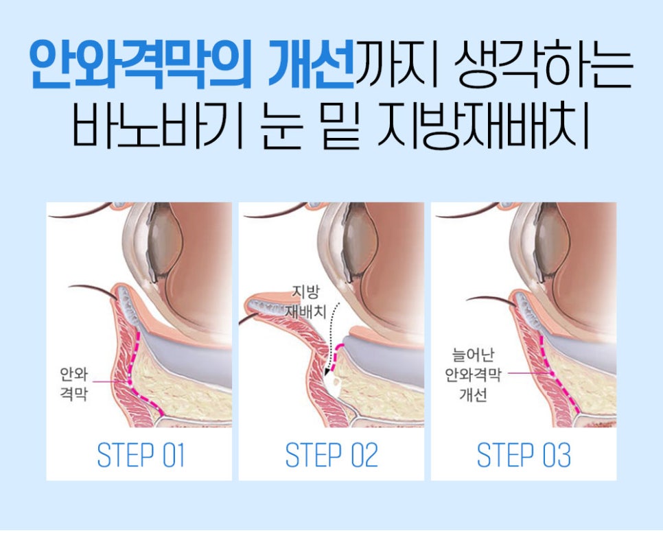 눈밑 지방재배치, 볼록하고 어두운 눈가를 환하게 개선 관련 이미지 5