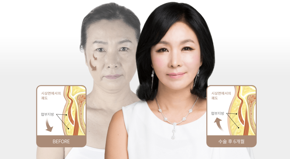 어떤 동안 성형보다 효과가 뛰어난 안면거상술 관련 이미지 8
