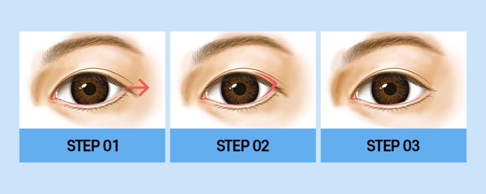 매력적인 눈매! 트임 성형만으로도 개선할 수 있습니다. 관련 이미지 3